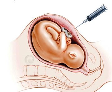 تشخیص پیش از بارداریPND ژن آزما