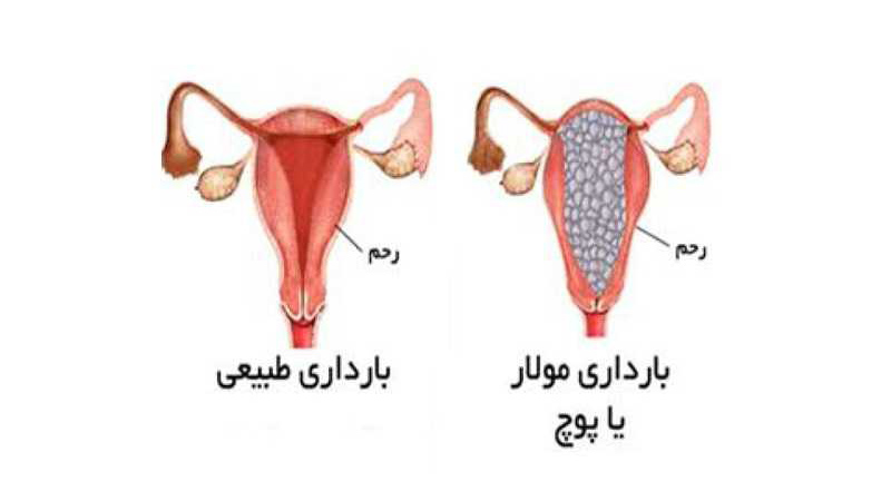 ژنوم | حاملگی مولار