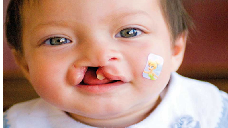 سندروم پاتو یا تریزومی 13 | آزمایش ژنتیک اصفهان