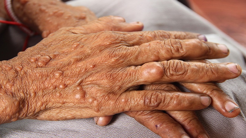 اختلال ژنتیکی نوروفیبروماتوز و علت آن | مشاوره ژنتیک اصفهان