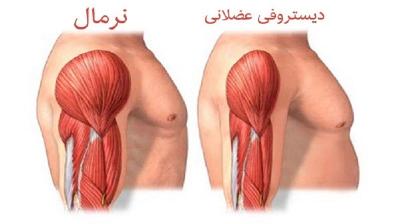 بیماری دیستروفی میوتونیک | آزمایش ژنتیک اصفهان