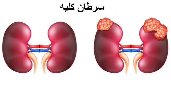 سرطان کلیه | علل و علائم | بهترین آزمایشگاه ژنتیک اصفهان