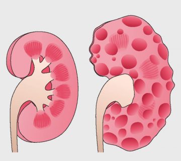 کلیه پلی کیستیک