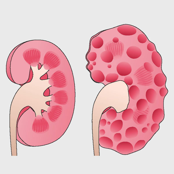 کلیه پلی کیستیک