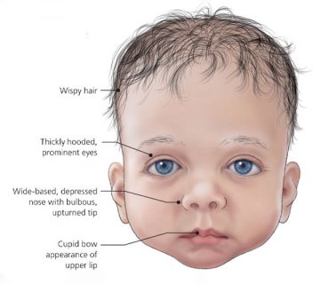 سندرم نشانگان نونان