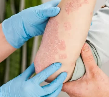 علائم پسوریازیس