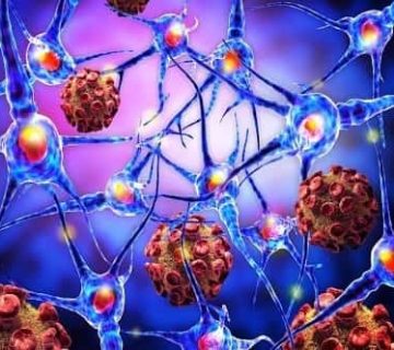 نوروفیبروماتوز نوع 1 (NF1)